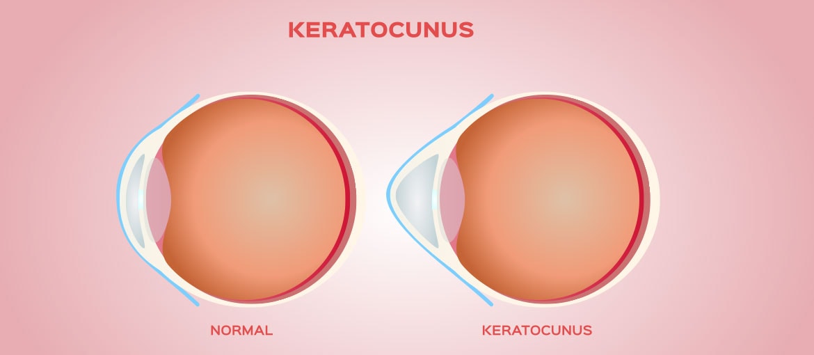 Keratoconus