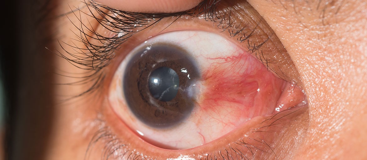 Pterygium